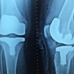 When Do You Require Orthopaedic Health Tips?