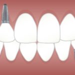 How to Choose a Dental Implant Specialist in Auckland?