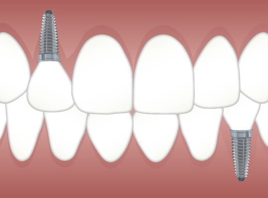 Dental Implant